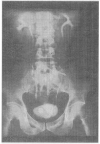 患者,男,36岁.下腰部不适半年,加重2周.静脉尿路造影见图.