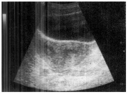 男32岁,超声示睾丸,内可探及多个结节状低回声