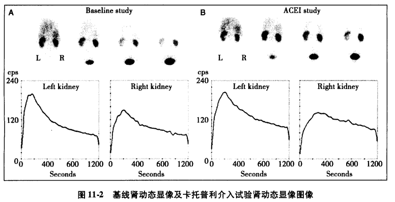 正常肾图曲线图片图片